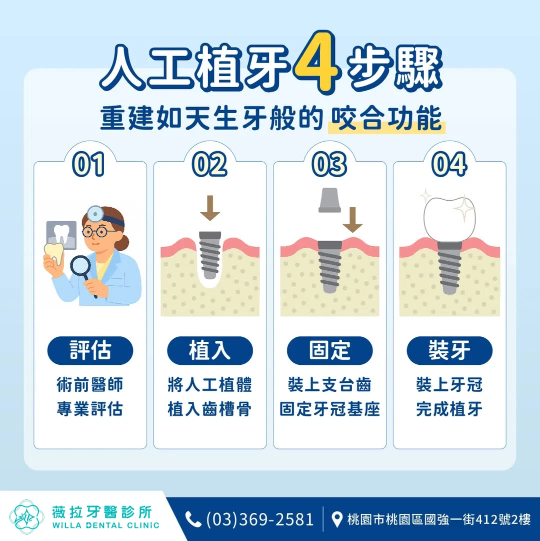 數位舒眠微創植牙【一顆4.3萬元】